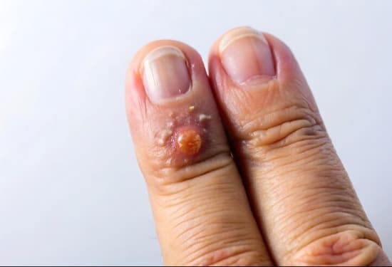 Wart Removal