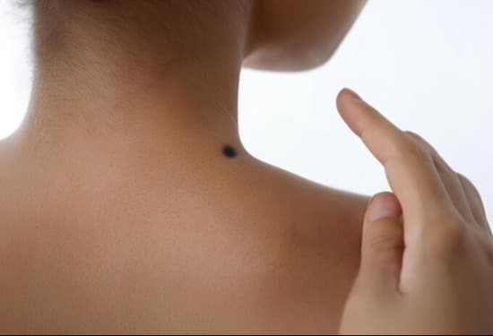 Mole Removal