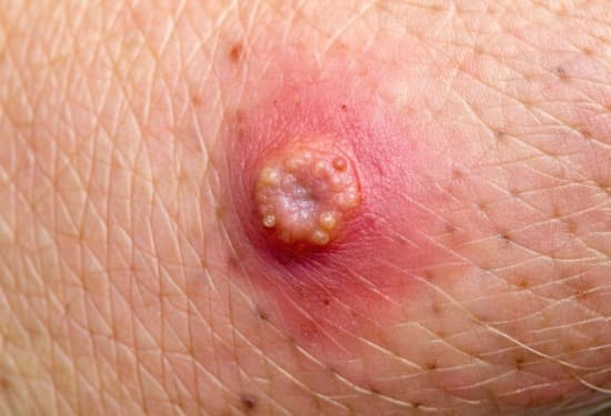Cyst Removal