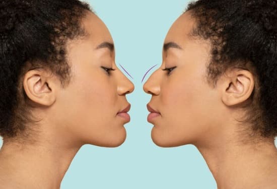 Botox for Nose Slimming
